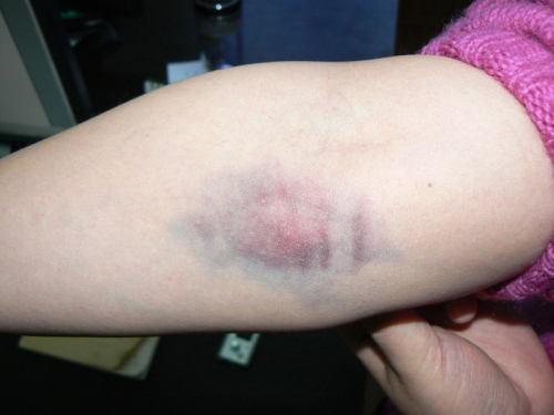 静脉采血后淤青发紫多久能好,抽完血手臂青紫图片