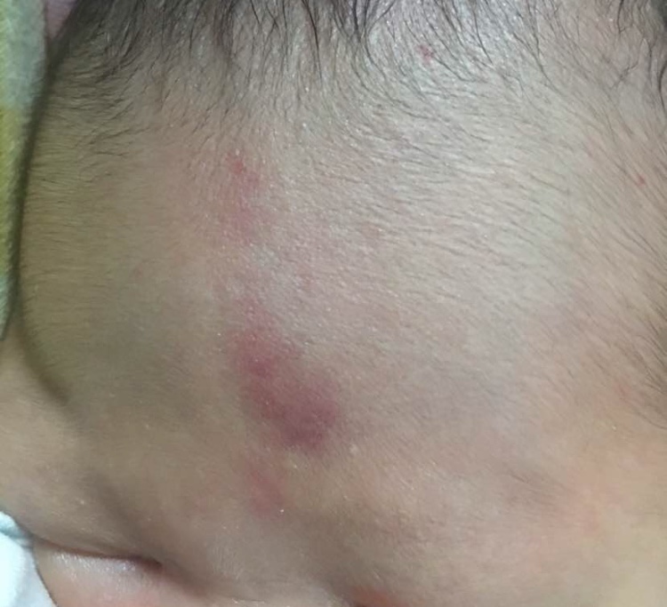 宝宝出生就有胎记是宝妈的原因吗,宝宝有胎记的宝妈们都去了吗