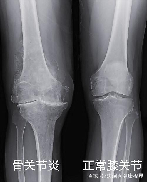 民间治疗骨性关节炎的妙方,得了骶髂关节炎怎么办