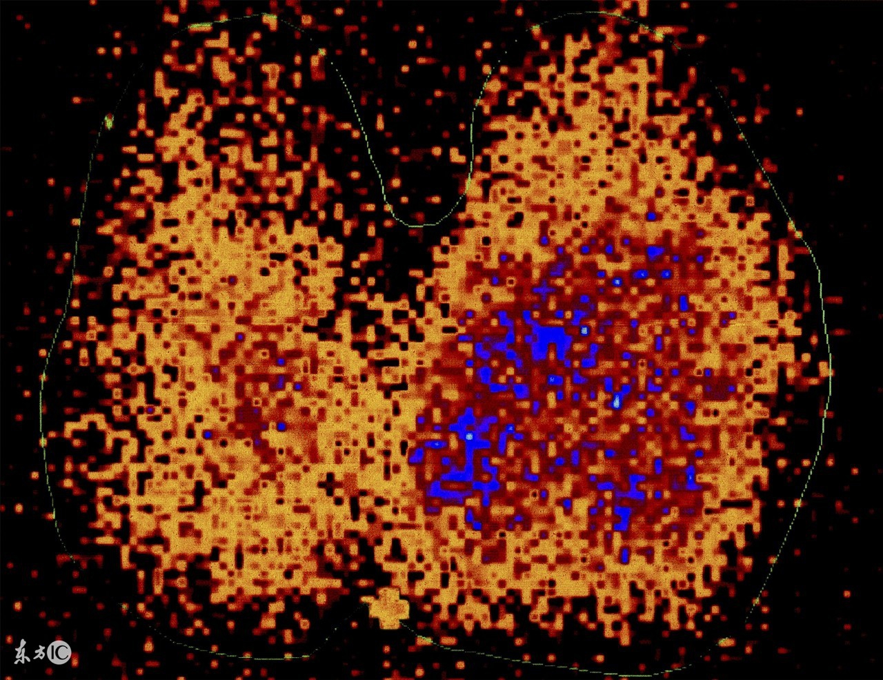 甲状腺素131碘试验,甲状腺碘131试验视频