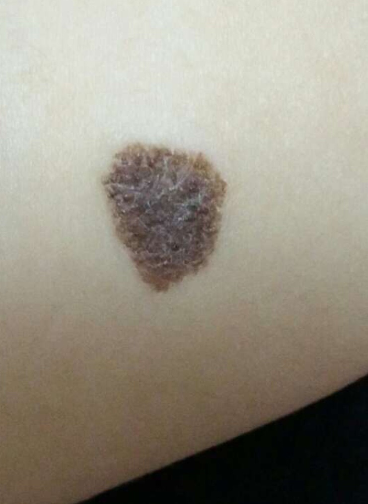 宝宝出生就有胎记是宝妈的原因吗,宝宝有胎记的宝妈们都去了吗