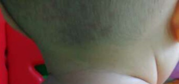 宝宝出生就有胎记是宝妈的原因吗,宝宝有胎记的宝妈们都去了吗