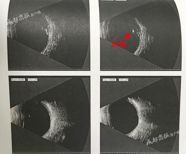 男子被铁片击中眼睛,一男子被铁片击中颈动脉大出血