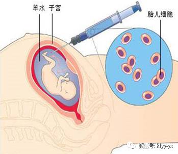 羊水穿刺时医生说羊水浑浊,妇产科医生告诉你顺产的真相