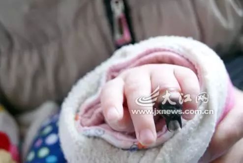 婴儿面临截肢,血泪的教训家长必知