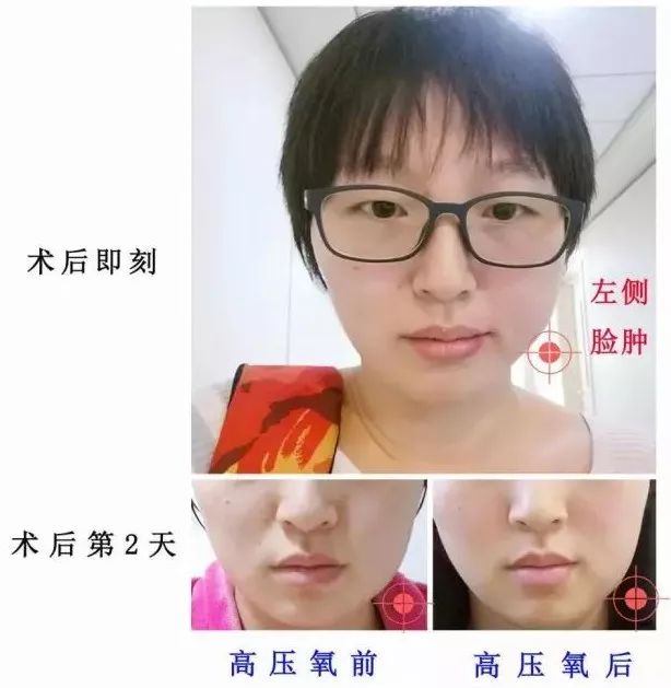 智齿拔牙后恢复的亲身经历,拔牙后感染是什么样的症状啊