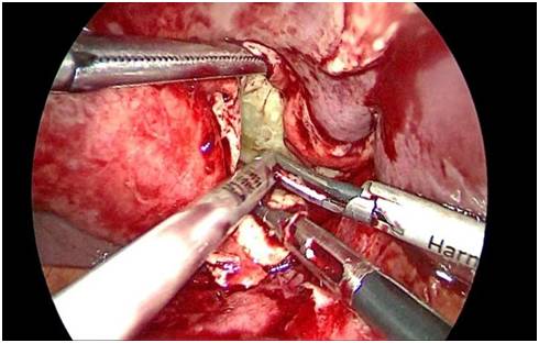 胃里有个大肿块是怎么回事,胃突然有个硬包怎么回事