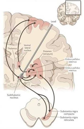 帕金森只是右手僵硬要吃药吗,帕金森只是手抖吗