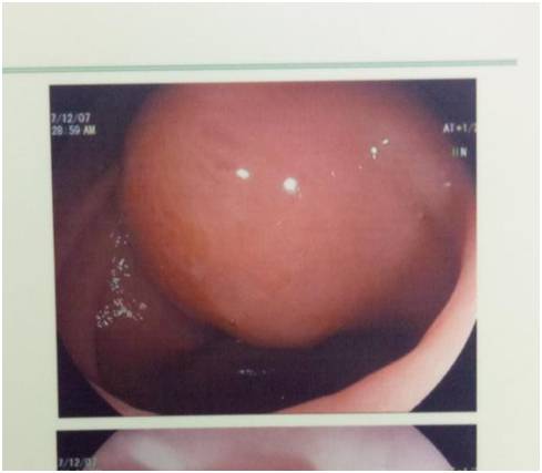 胃里有个大肿块是怎么回事,胃突然有个硬包怎么回事