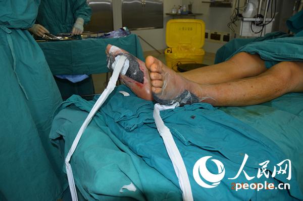 创伤治疗有了新方法你知道什么是VSD吗？