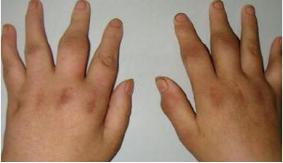 中医鬼才倪海厦类风湿治疗,全国最权威的类风湿中医专家