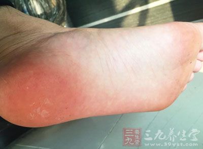 中医张仲景治脚气的特效方子,治脚气的中药泡脚方子