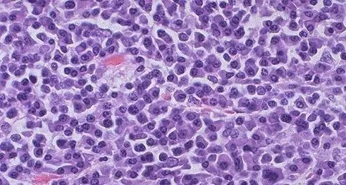 血液肿瘤的CAR-T治疗靶点点评集锦