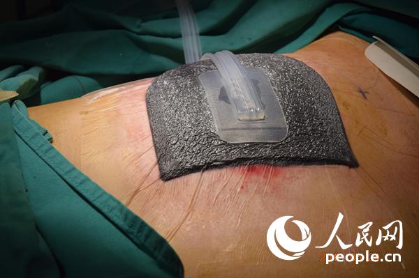 创伤治疗有了新方法你知道什么是VSD吗？