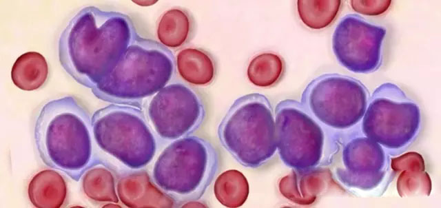 血液肿瘤的CAR-T治疗靶点点评集锦