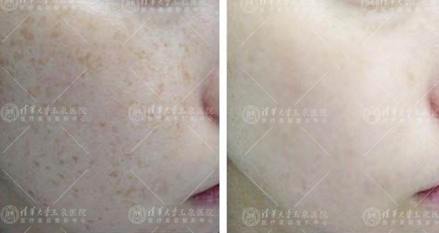 表皮部位色素治疗——遇到雀斑怎么办