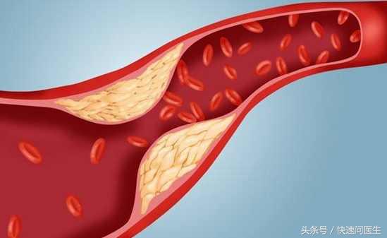 下肢动脉血栓的症状与危害,下肢动脉血栓能治好吗