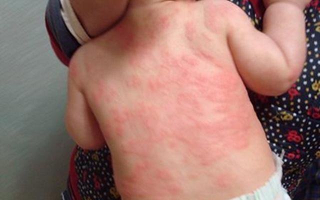 孩子吃药过敏了怎么确认没事了,医院开的药导致孩子过敏