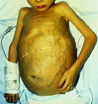 远离肝硬化5大征兆,6个征兆说明已经有肝硬化了