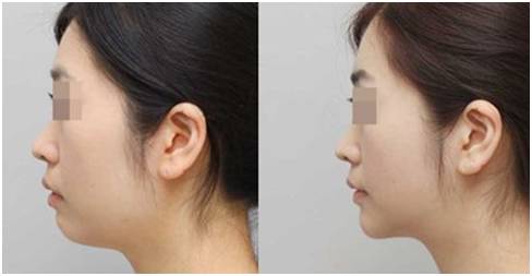 玻尿酸是瘦脸还是填充,玻尿酸填充脸颊会有提拉效果吗