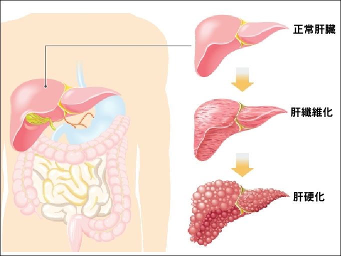 远离肝硬化5大征兆,6个征兆说明已经有肝硬化了