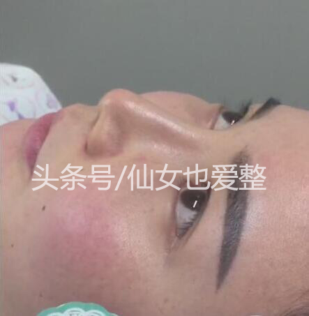 鼻综合隆鼻用什么材料,耳软骨和肋骨隆鼻费用多少钱