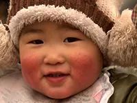 天生高原红的脸用什么修复,高原红的脸用什么修复敏感肌