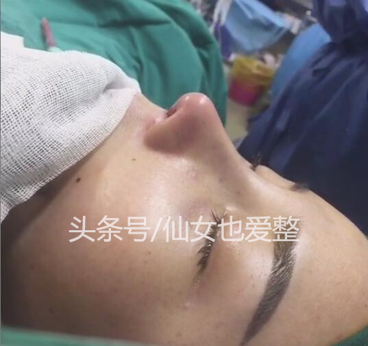 鼻综合隆鼻用什么材料,耳软骨和肋骨隆鼻费用多少钱