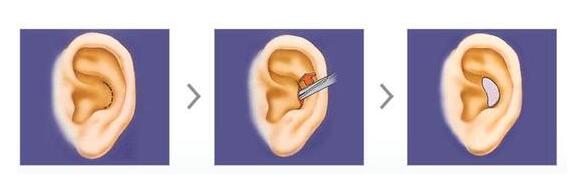 鼻综合隆鼻用什么材料,耳软骨和肋骨隆鼻费用多少钱