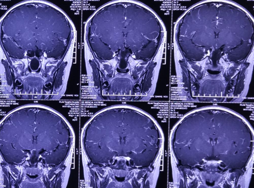 脑膜膨出手术是用什么修补的,蝶鞍区脑膜膨出手术怎么做