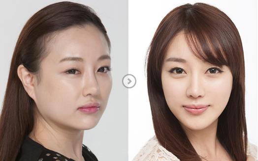 自体脂肪填充泪沟多久恢复自然,自体脂肪填充泪沟多久恢复正常