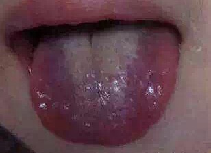 舌诊剥苔,小儿怎样看舌苔辨病症