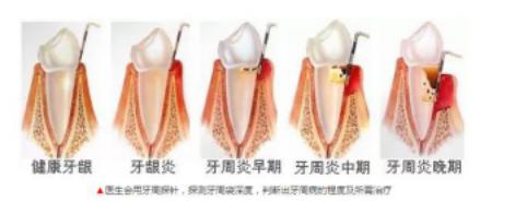 科普牙周小知识,牙周基础知识大全