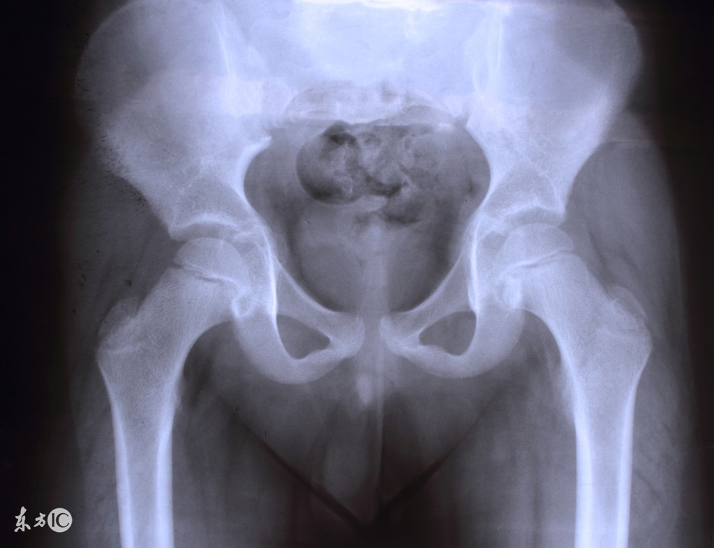 女性盆腔积液,了解病因,做好预防