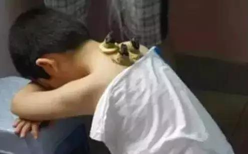 小孩用艾灸可以退烧吗,小孩用艾灸和热敷哪个好