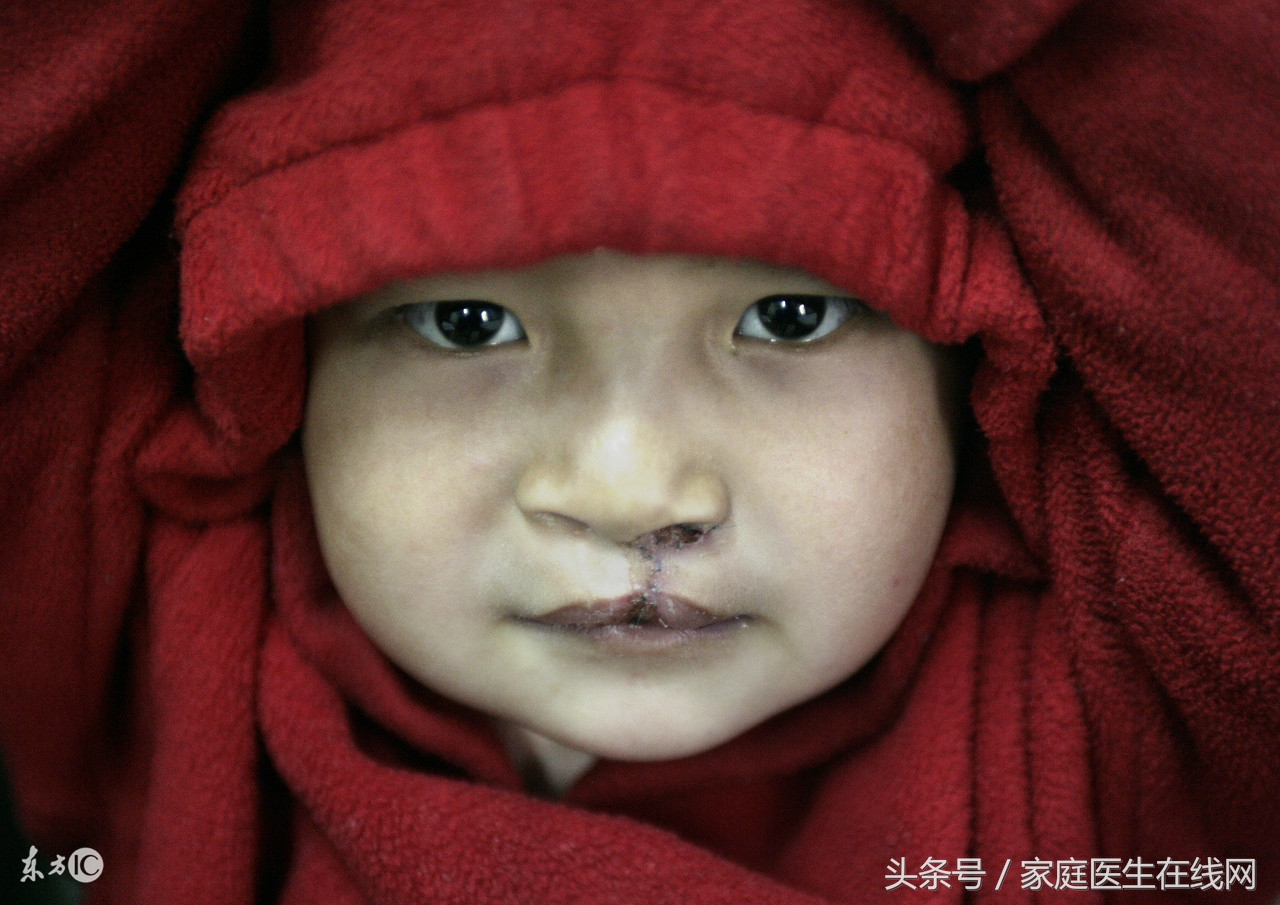 胎儿唇腭裂出生后能修复吗,唇腭裂刚出生可以修复吗