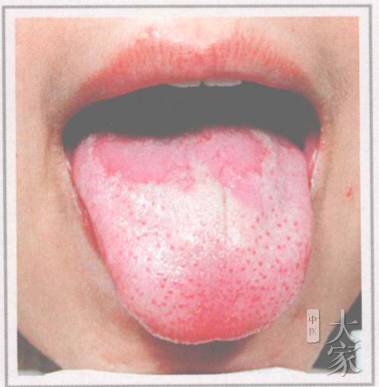 舌诊剥苔,小儿怎样看舌苔辨病症