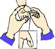 小儿肺炎发烧推拿手法,武汉极鹤小儿推拿