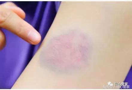 髂动脉支架术后都有什么症状,心脏支架术后最常见的9大症状