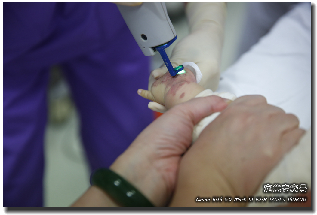 皮肤专家诊室故事连载之五，手心和眉心“开天眼”？