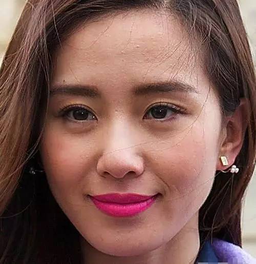 闭口怎么破？看完这篇不困惑