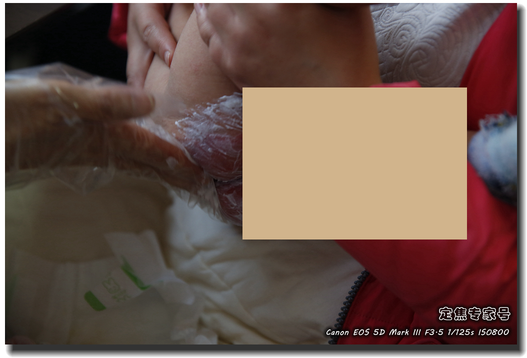 皮肤专家诊室故事连载之五，手心和眉心“开天眼”？