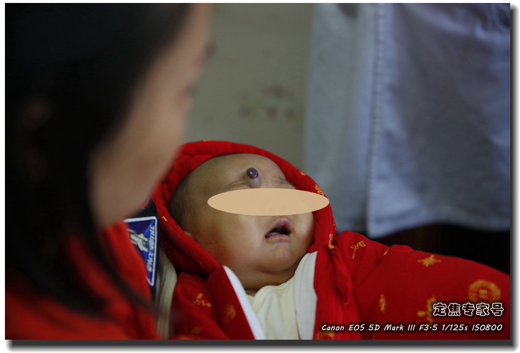 皮肤专家诊室故事连载之五，手心和眉心“开天眼”？