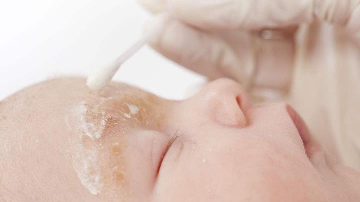 脂溢性皮炎皮肤红彤彤的怎么治,脂溢性皮炎又红又痒