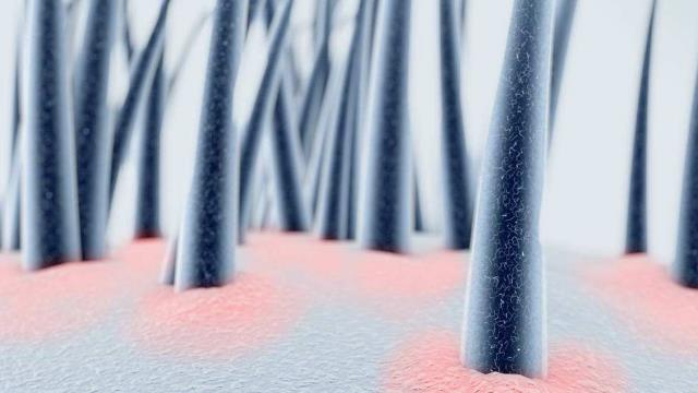 脂溢性皮炎皮肤红彤彤的怎么治,脂溢性皮炎又红又痒