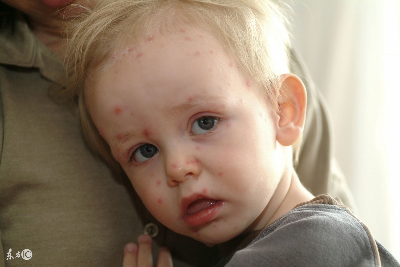 父母须知水痘高发季节风险提示,家长掌握水痘的预防和护理方法