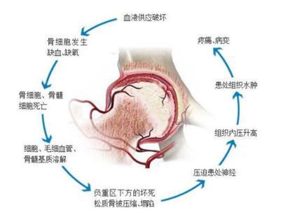 股骨头坏死该如何治疗？给你这三个建议！