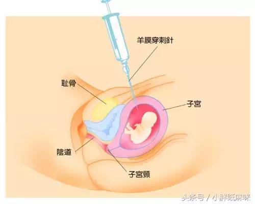 唐氏筛查无创dna和羊水穿刺哪个好,nt3.3做无创dna还是羊水穿刺