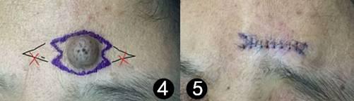 痣上长小疙瘩是什么原因,痣小比较深怎么办