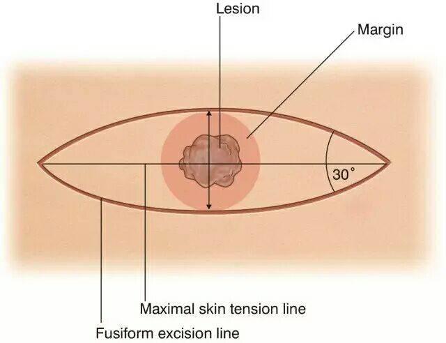 痣上长小疙瘩是什么原因,痣小比较深怎么办